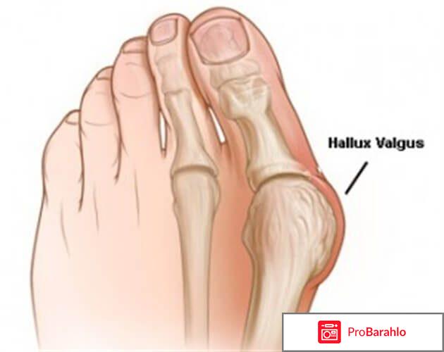 Hallux Valgus 