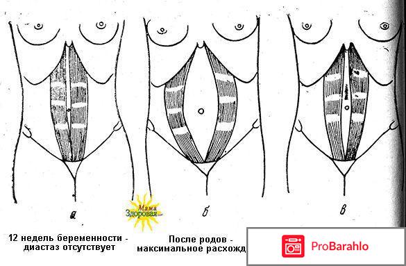 Как убрать живот после родов - комплексный подход 