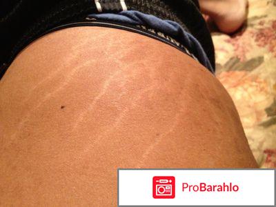 Как избавиться от растяжек на ногах? 