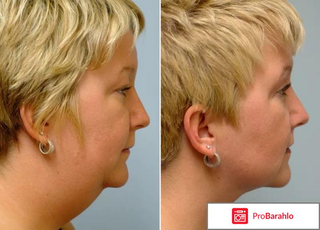 Липолитики для подбородка реальные отзывы