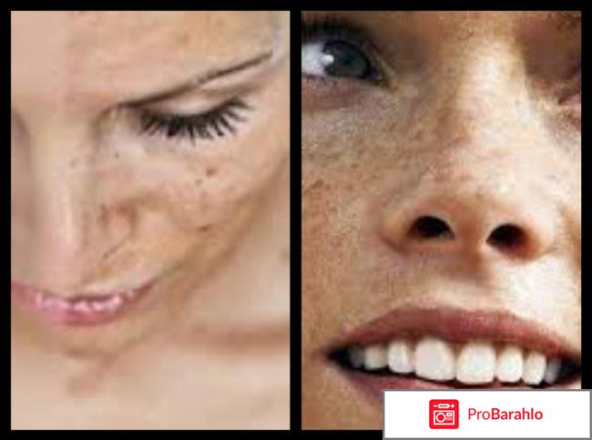 Как избавиться от пигментации лица быстрее всего 