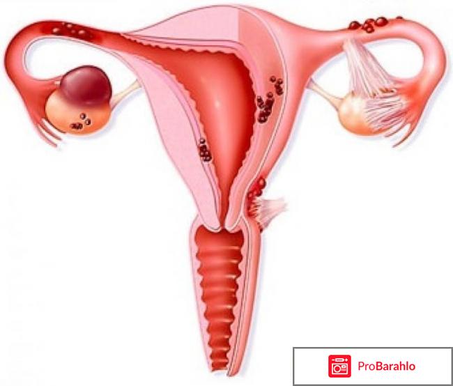 Как лечить эндометриоз матки 