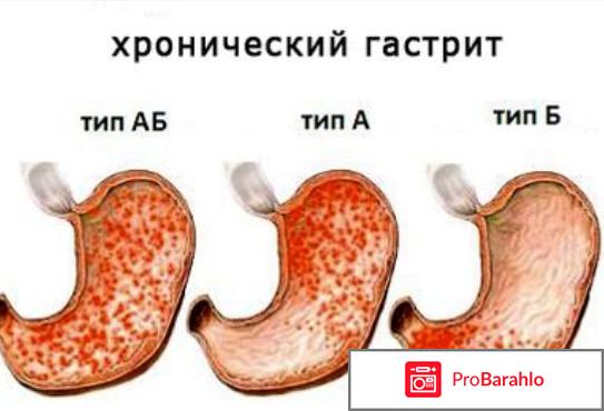 Как отличить гастрит с повышенной и пониженной кислотностью 