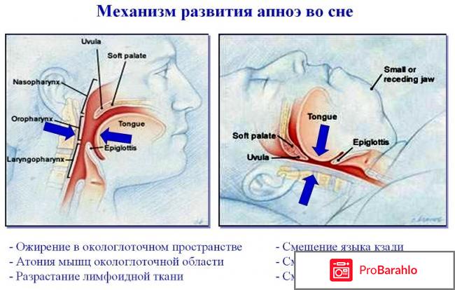 Синдром ночного апноэ: причины, симптомы, лечение отрицательные отзывы