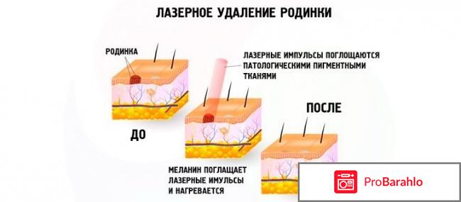 Удаление родинок лазером в спб отзывы отрицательные отзывы