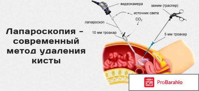 Лапароскопия отзывы после операции 