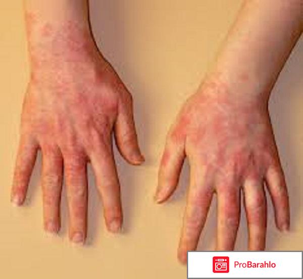 Акридерм гк мазь инструкция по применению цена 