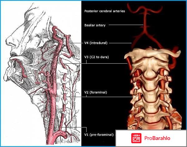 Гипоплазия позвоночной артерии отзывы владельцев