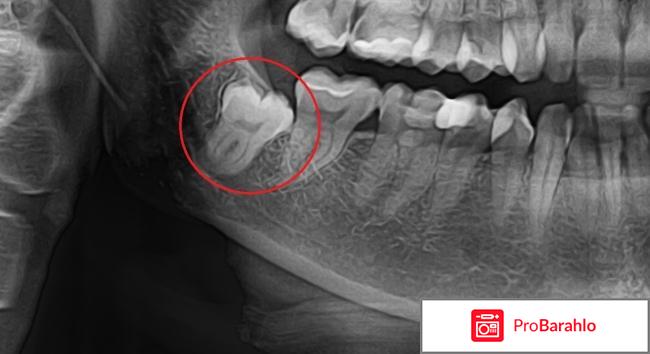 Удаление ретинированного зуба мудрости 