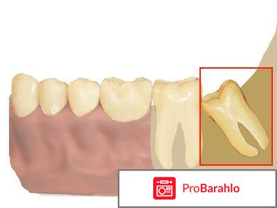Сложное удаление зуба мудрости 