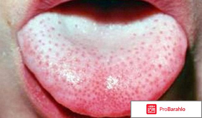 Пятна на языке у взрослых и детей, причины обман