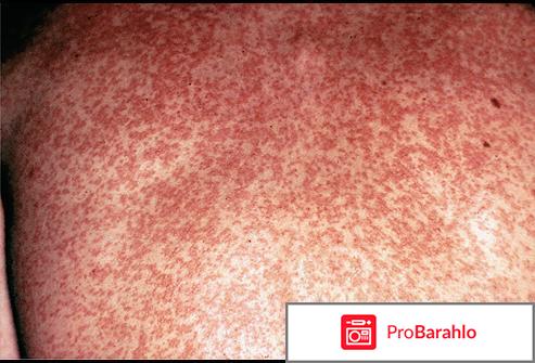 Краснуха фото 