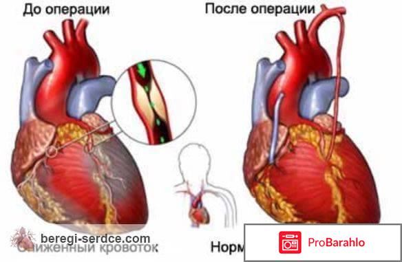 Коронарное шунтирование 