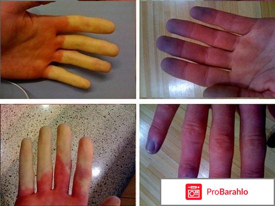 Синдром Рейно: причины, стадии, симптомы, лечение 