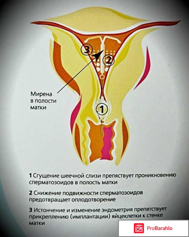 Мирена отзывы женщин после 45 лет обман