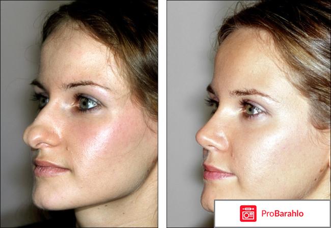 Пластика носа фото отрицательные отзывы