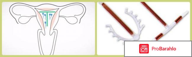 Внутриматочная спираль отзывы врачей обман