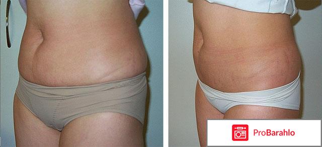 Липолитики от целлюлита 