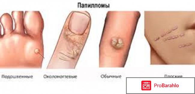 Панавир гель от папиллом отзывы 