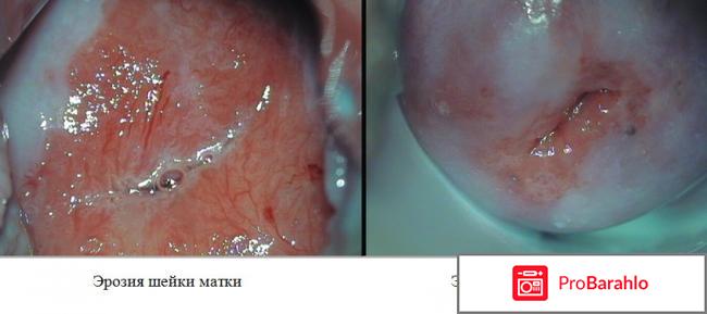 Лечение шейки матки народными средствами отрицательные отзывы