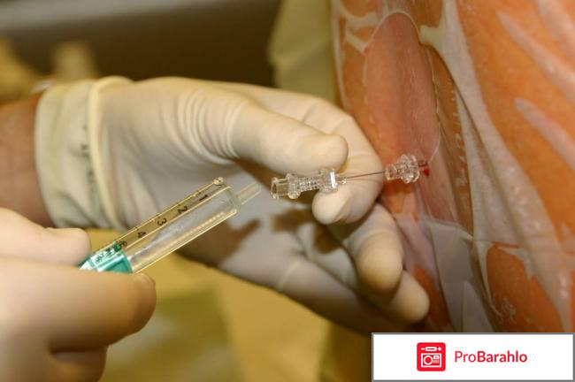 Блокады при остеохондрозе обман