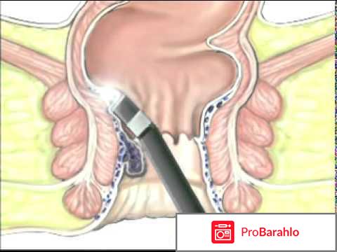 Удаление геморроидальных узлов отрицательные отзывы