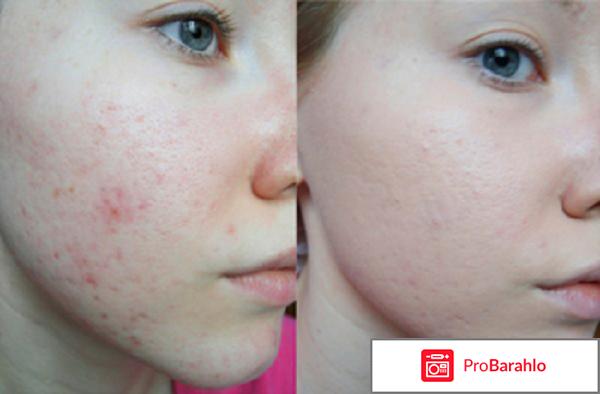 Базирон ас отзывы покупателей обман