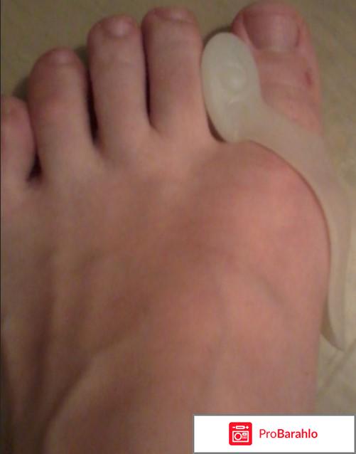 Фиксатор большого пальца valgus pro отзывы реальные отзывы