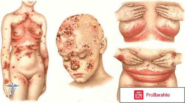 Как победить молочницу 