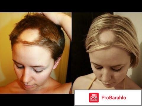 Шампунь алерана для роста отзывы отзывы владельцев