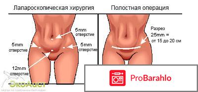 Лапароскопия отзывы обман