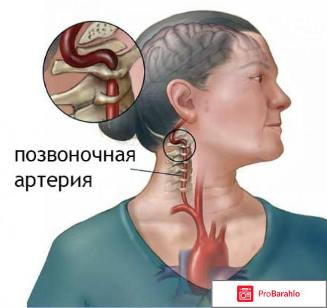 Синдром цервикокраниоалгии позвоночной артерии отрицательные отзывы