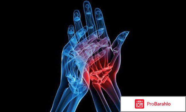 Артропант (Artropant) реальные отзывы