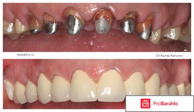 Коронки металлокерамика обман