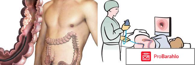 Колоноскопия кишечника: показания, подготовка, этапы 