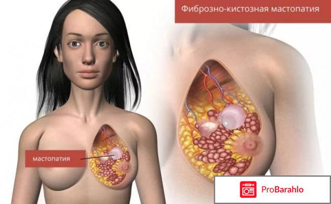 Препараты от мастопатии 