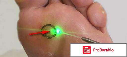 Удаление мозолей лазером отзывы обман