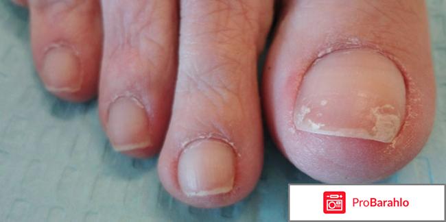 Стоп актив от грибка ногтей отрицательные отзывы