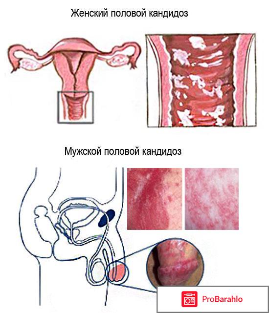 Молочница у женщин отзывы отрицательные отзывы