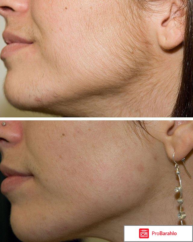 Эпиляция на лице отрицательные отзывы