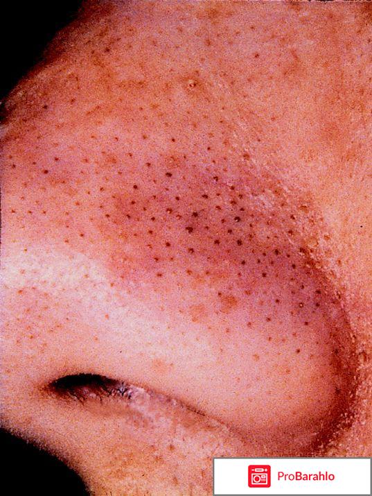 Как избавиться от комедонов на лице в домашних условиях обман