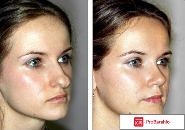 Пластика носа фото обман