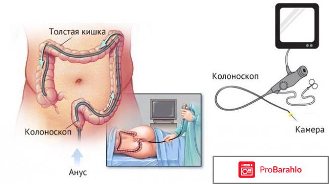 Больно ли делать колоноскопию 