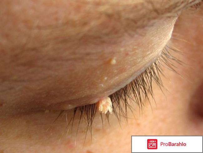 Вирус папилломы человека лечение отзывы обман