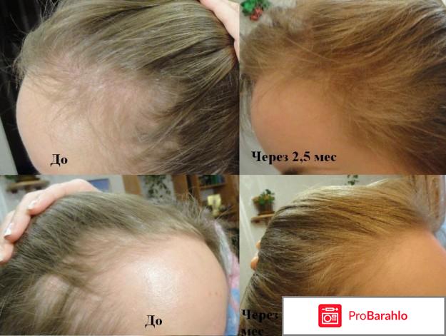 Миноксидил для волос для женщин отрицательные отзывы