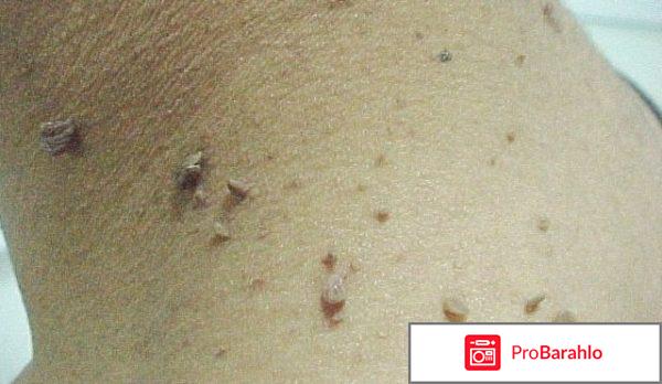 Хозяйственное мыло от папиллом отрицательные отзывы