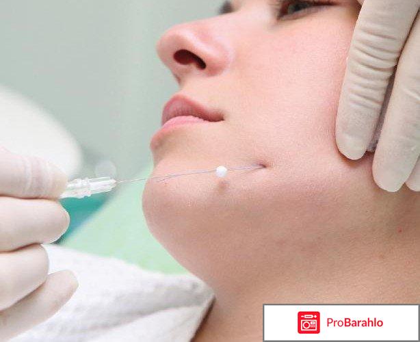 Мезонити для подтяжки лица отзывы отрицательные отзывы