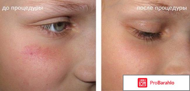 Крем от купероза на лице отзывы отзывы владельцев