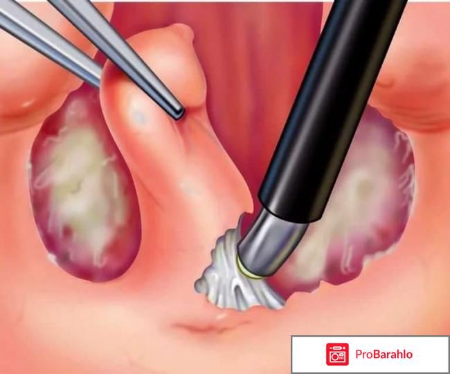 Холодноплазменная тонзиллэктомия отзывы 
