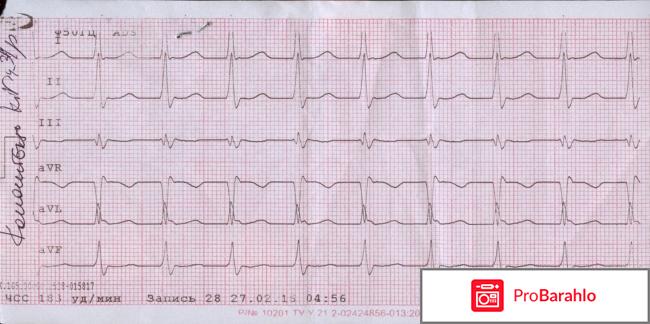 Тахикардия отрицательные отзывы
